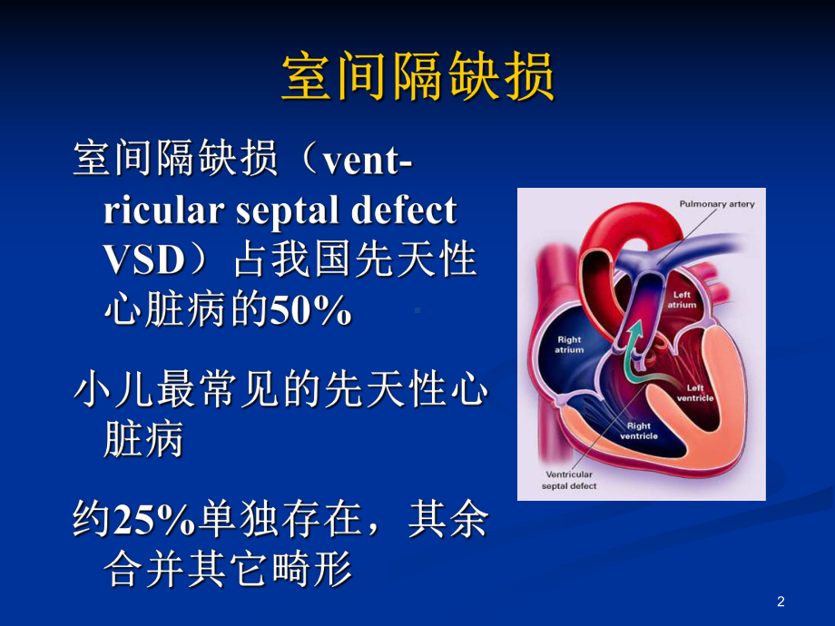 室间隔缺损PPT参考幻灯片课件.ppt_第2页