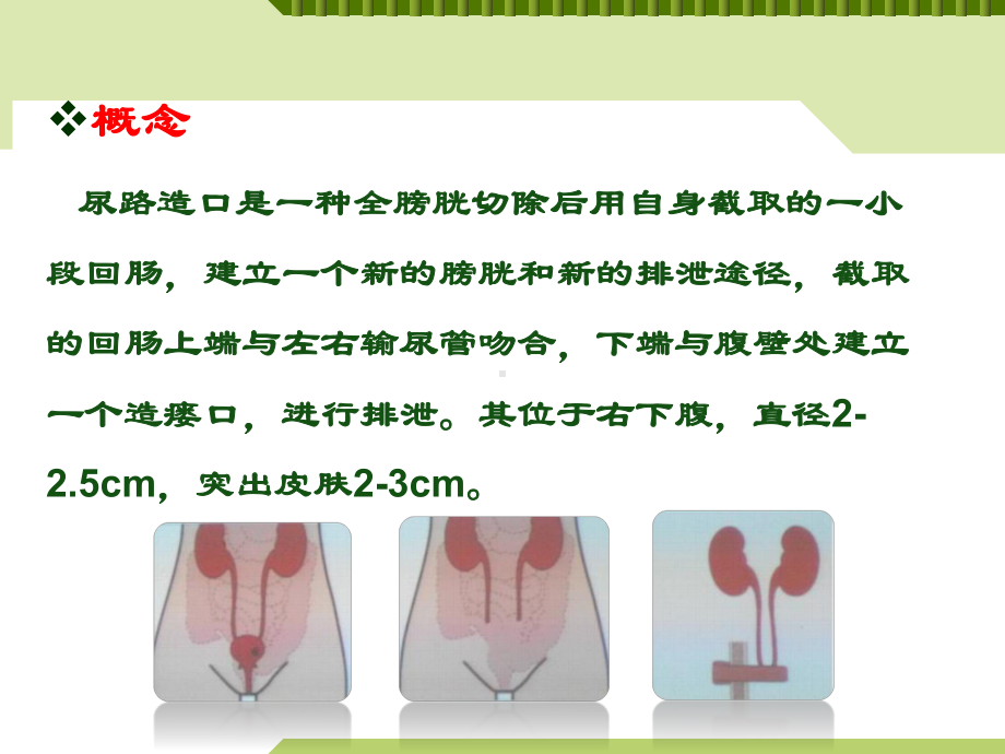 尿路造口病人手术初期护理课件.pptx_第2页