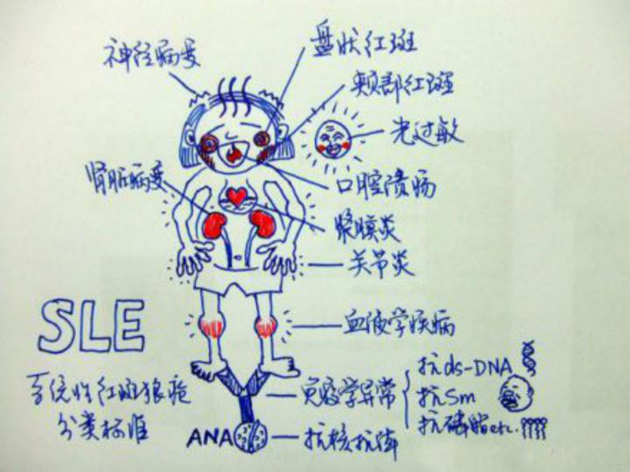 内科护理学系统性红斑狼疮的护理课件.pptx_第2页