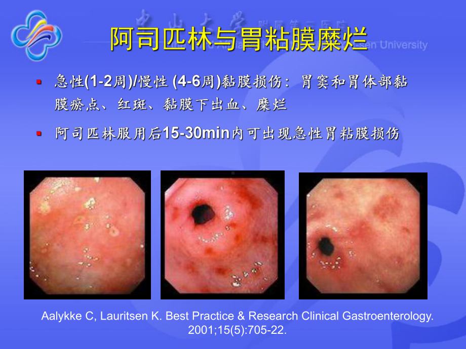 NSAIDs相关性胃粘膜损伤的防治课件.pptx_第2页