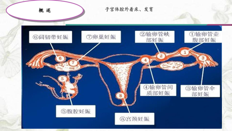 2020年宫外孕失血性休克的护理(课件).ppt_第3页