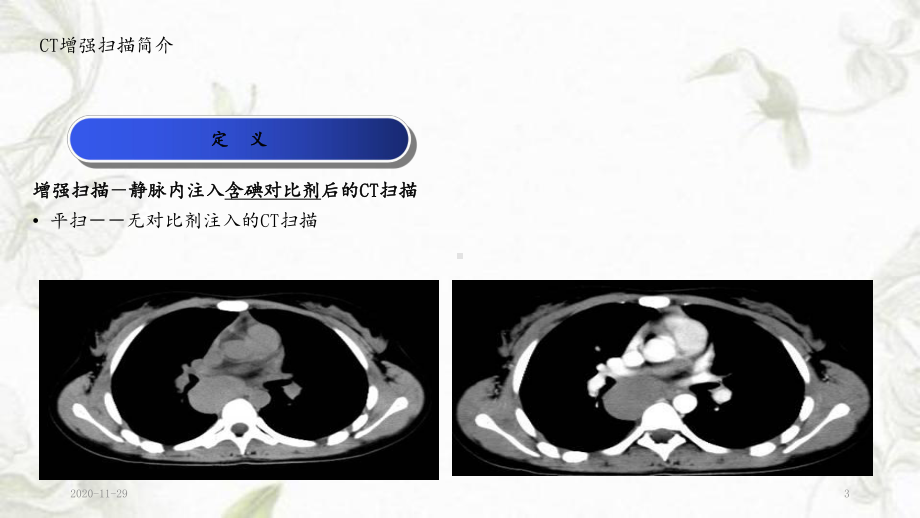 2020年CT增强扫描的临床应用(课件).ppt_第3页