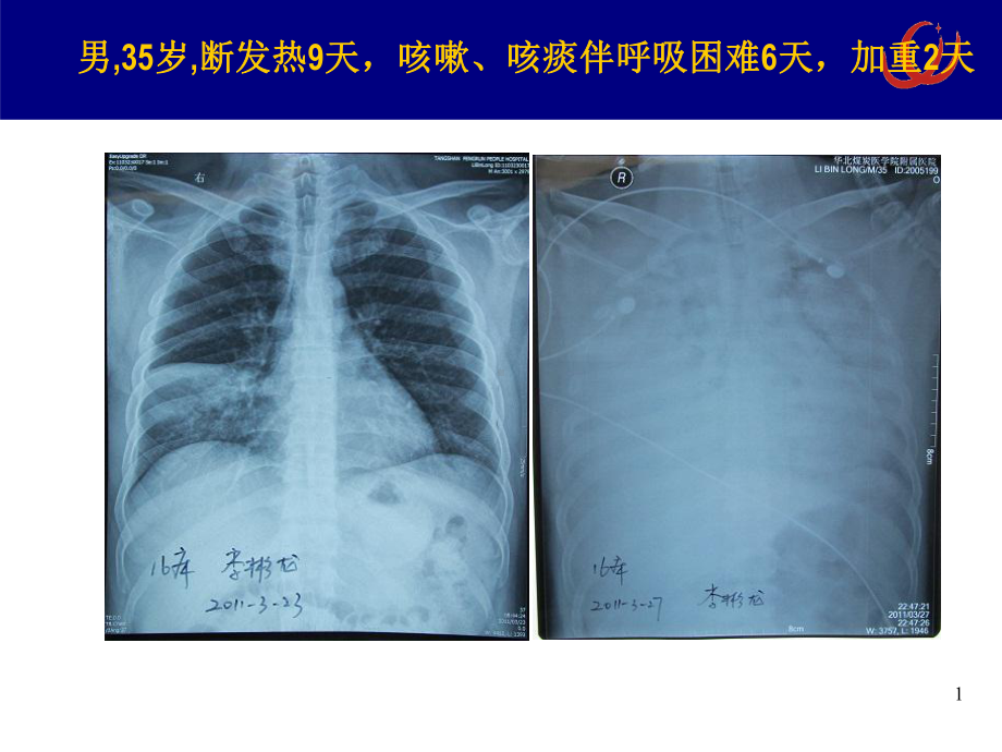 ECMO的安全性ppt课件.ppt_第3页