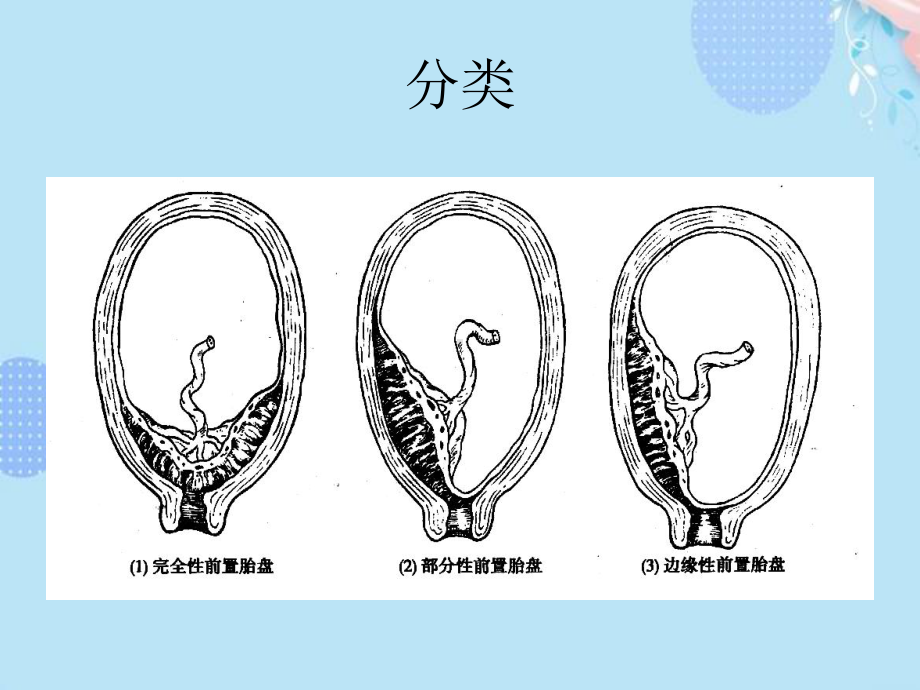 前置胎盘护理完整版PPT课件.ppt_第3页