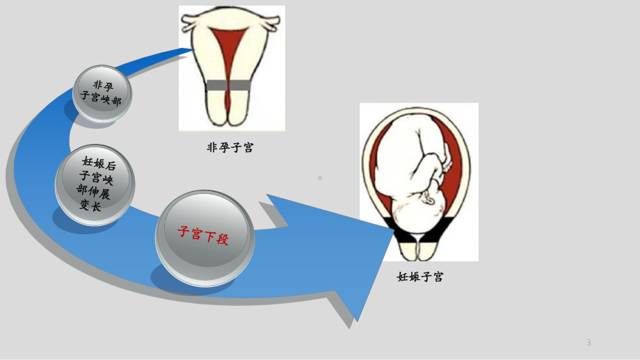 前置胎盘与胎盘植入影像表现精品PPT课件.pptx_第3页