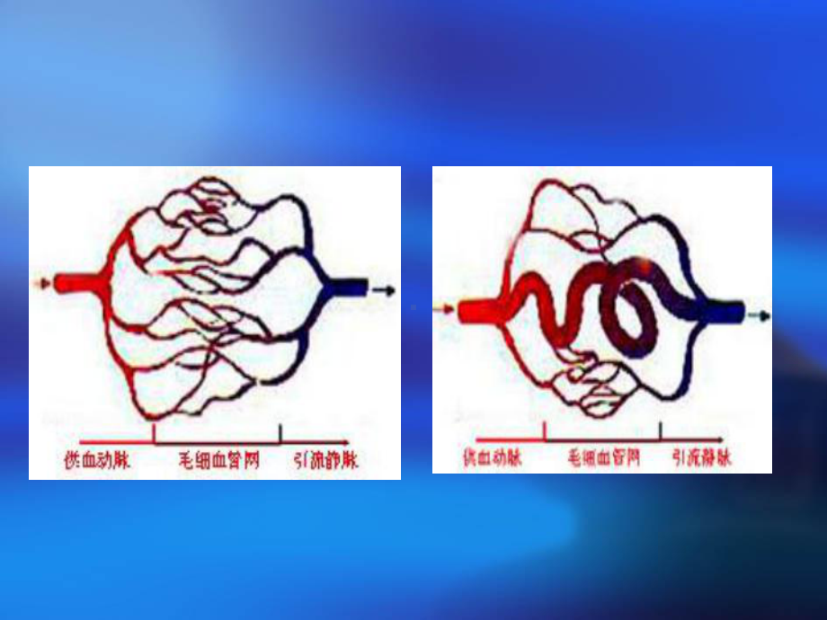 动静脉畸形讲义课件.ppt_第3页