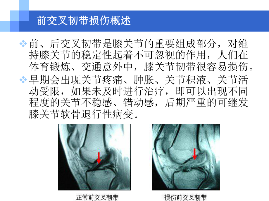 关节镜下ACL重建技术及等距重建在交叉韧带重建术中的意义课件.ppt_第2页