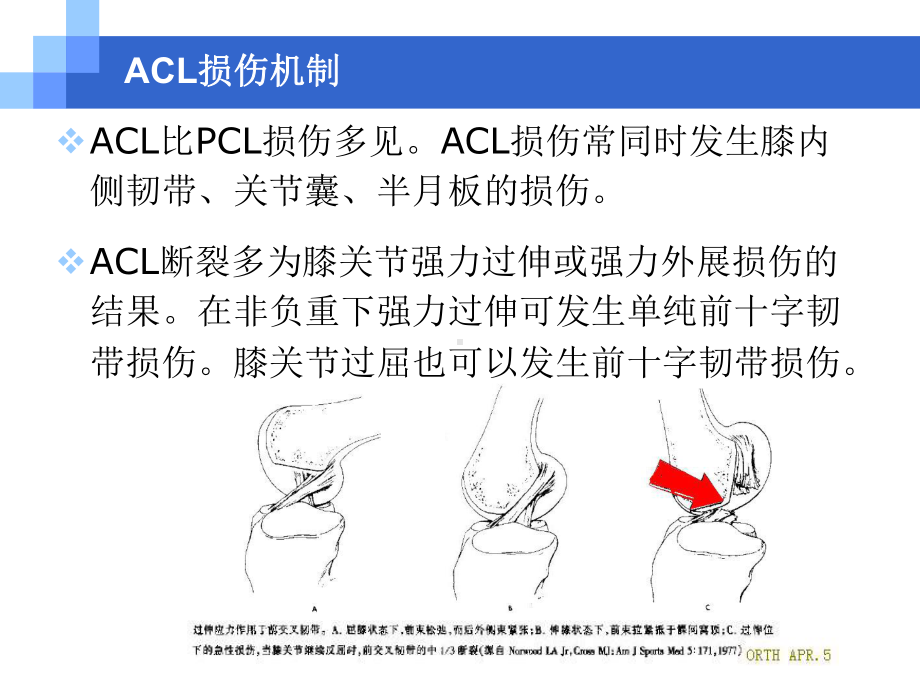 关节镜下ACL重建技术及等距重建在交叉韧带重建术中的意义课件.ppt_第3页