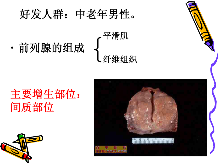 前列腺增生的护理课件.ppt_第1页