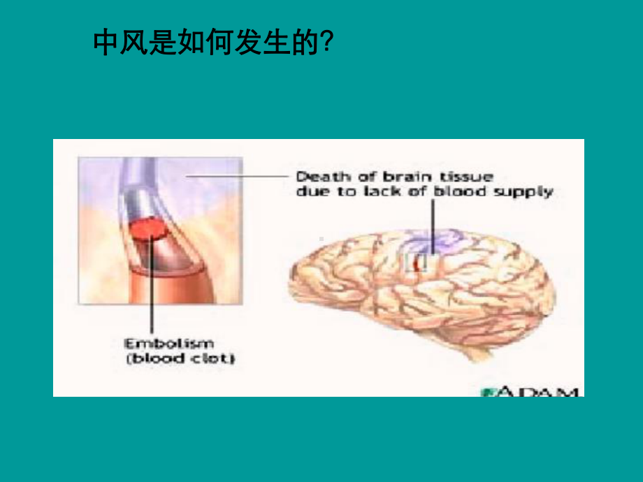 中风病的中医药治疗思路与方法课件.ppt_第2页