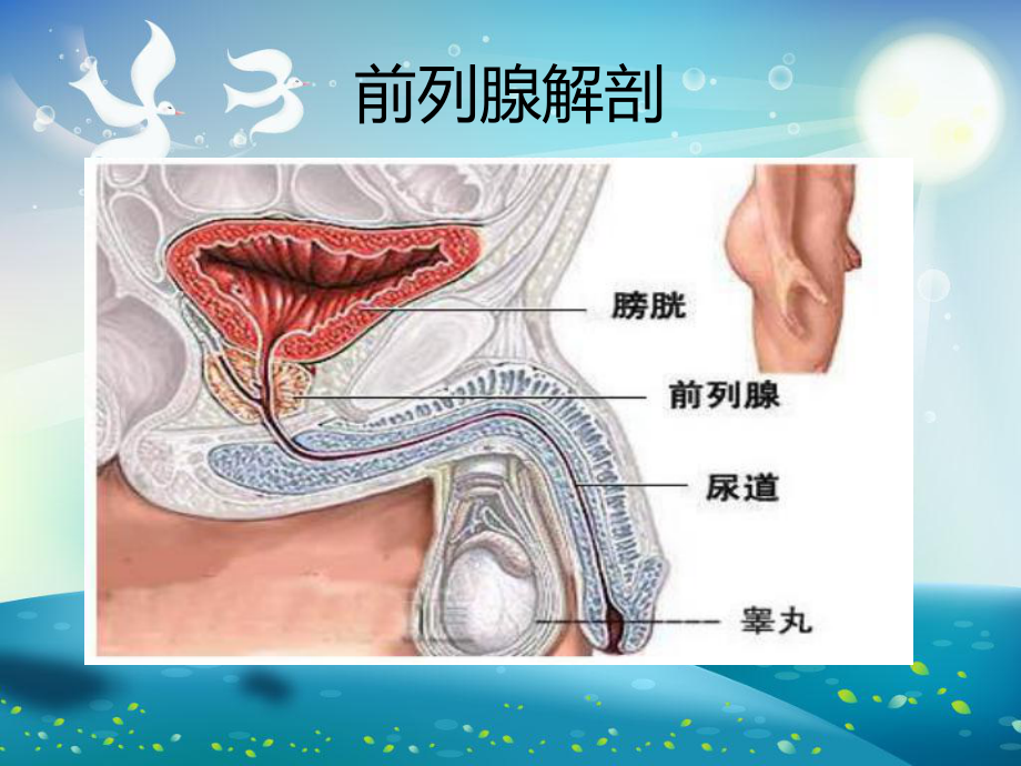 前列腺癌患者的护理查房课件.ppt_第2页