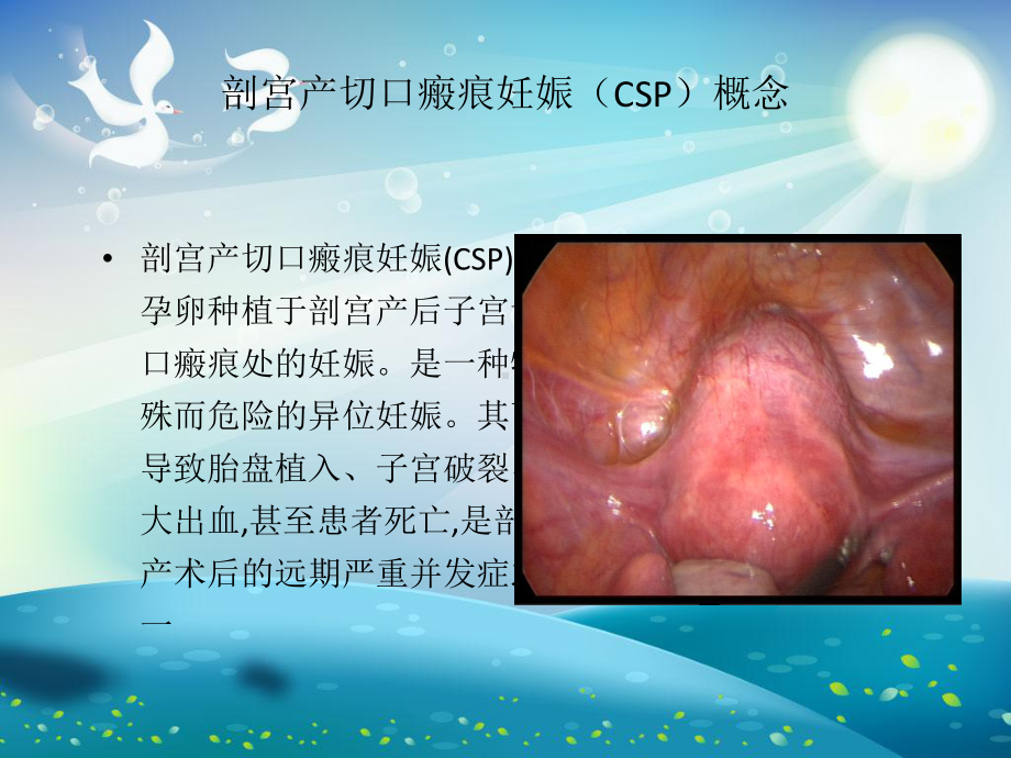 切口妊娠课件.ppt_第1页