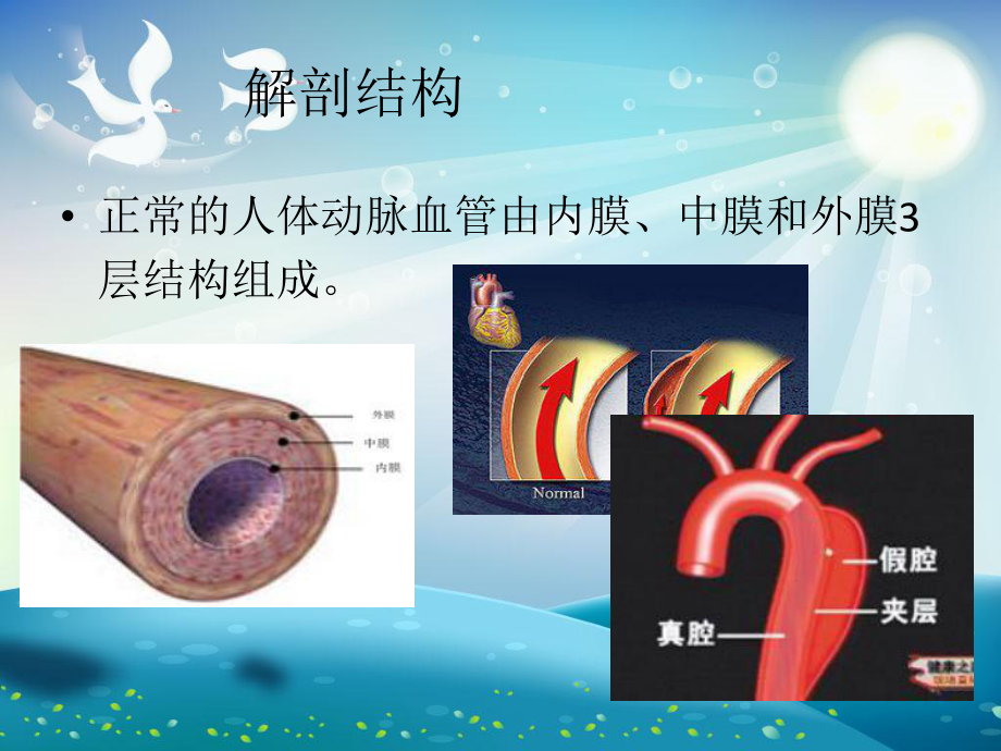 冠状动脉夹层护理查房课件.ppt_第3页