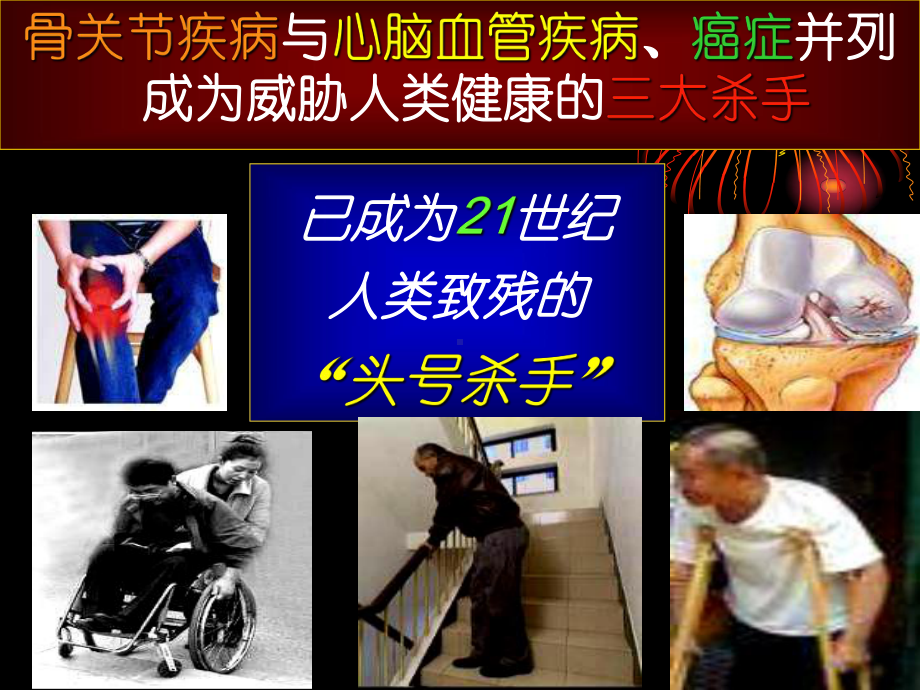 不死的癌症骨关节病课件.ppt_第3页