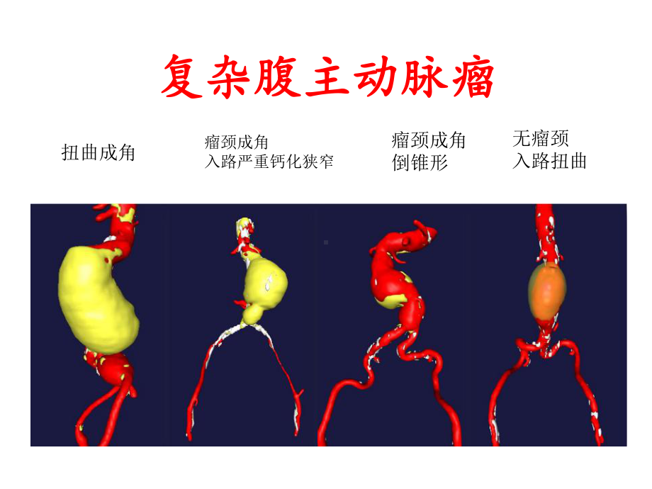 医学交流课件：何为复杂腹主动脉瘤最适合的治疗方法.pptx_第2页