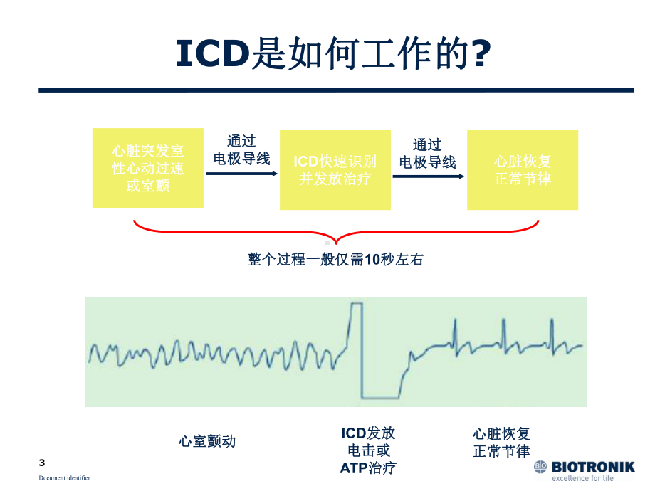 医学ICD疗法及适应证简介PPT培训课件.ppt_第3页