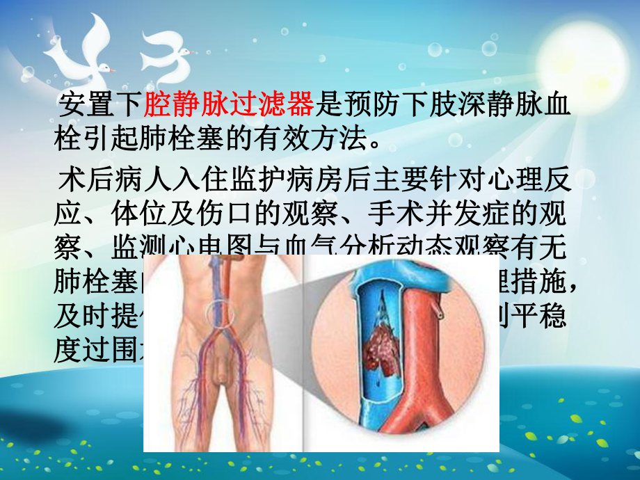 下腔静脉滤器植入术后护理课件.ppt_第2页