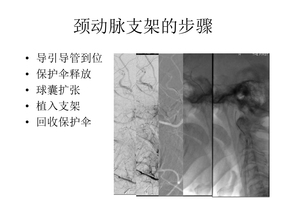 医学交流课件：颈动脉支架常见问题的预防与处理.pptx_第2页