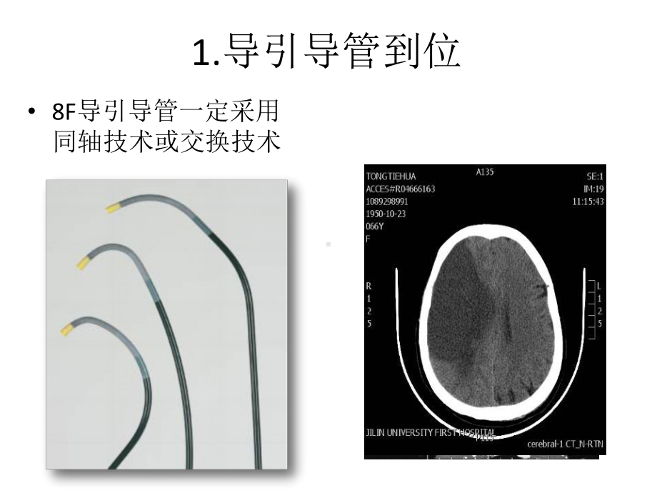 医学交流课件：颈动脉支架常见问题的预防与处理.pptx_第3页