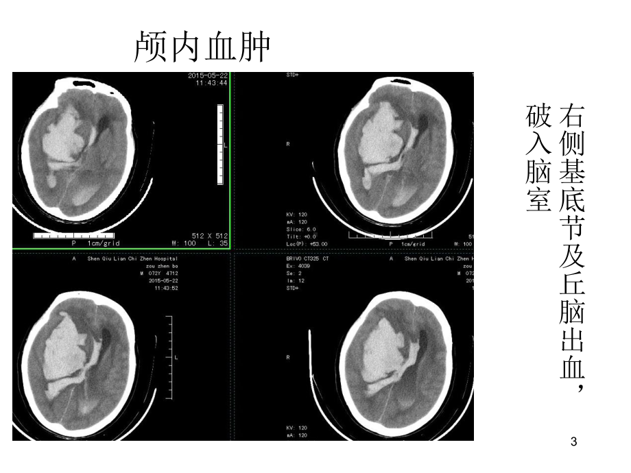 危急值-放射科ppt课件.ppt_第3页