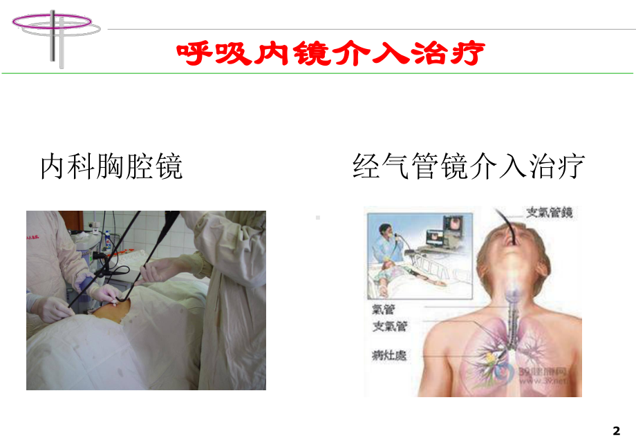 呼吸内镜介入治疗新进展PPT培训课件.ppt_第2页