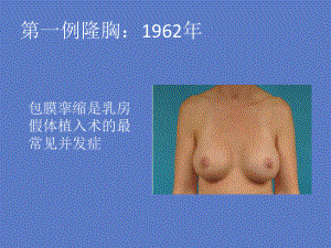 医学课件乳房假体植入手术常见并发症包膜挛缩.ppt