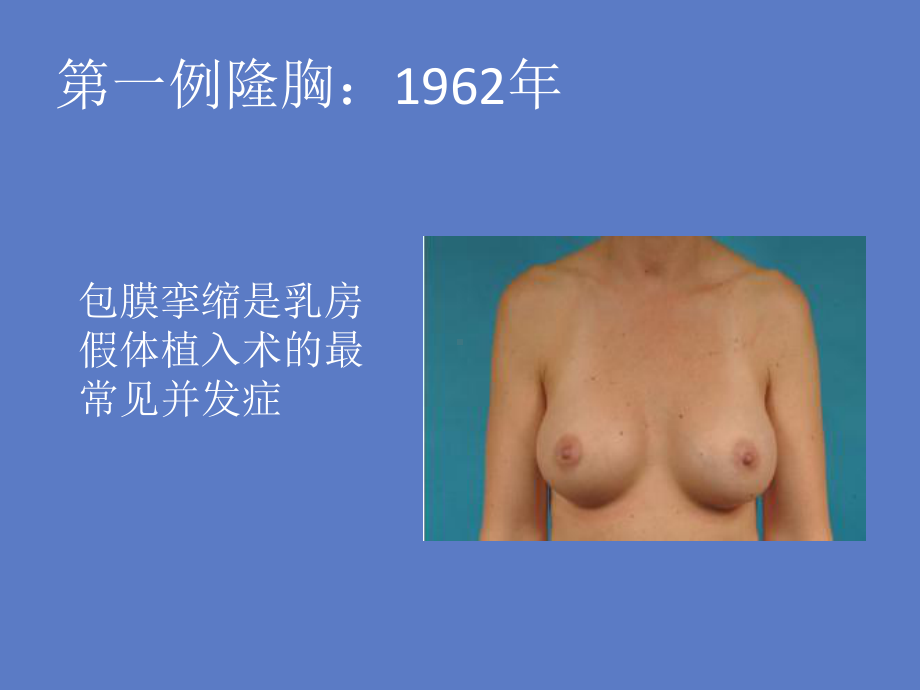 医学课件乳房假体植入手术常见并发症包膜挛缩.ppt_第1页