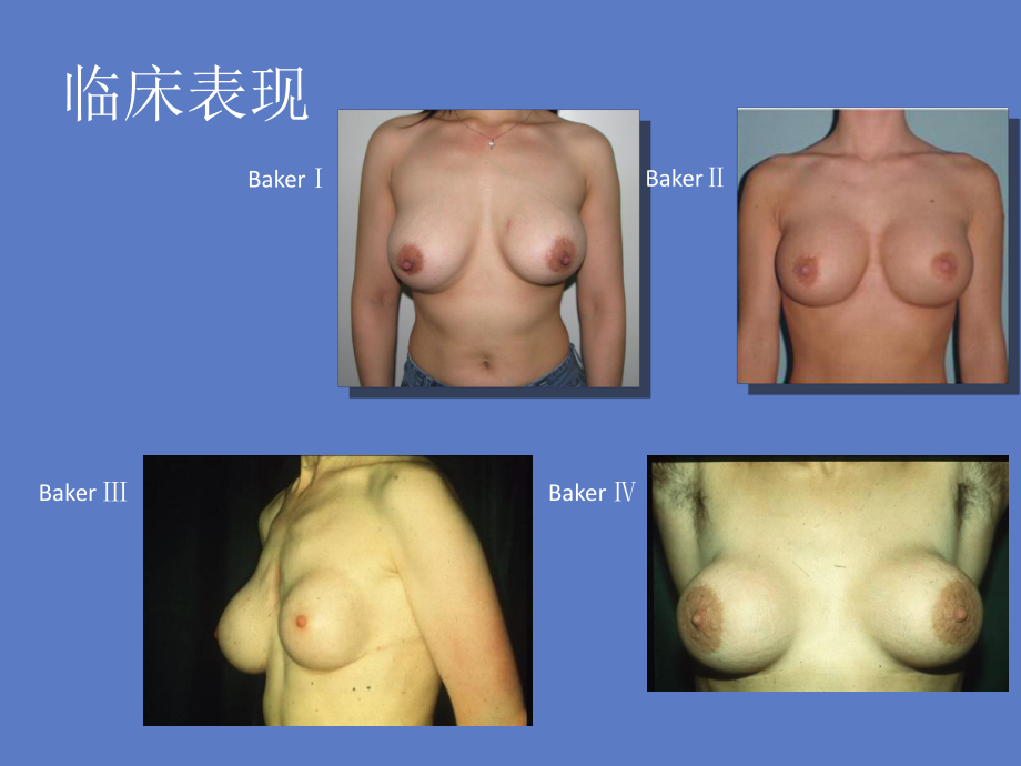 医学课件乳房假体植入手术常见并发症包膜挛缩.ppt_第3页