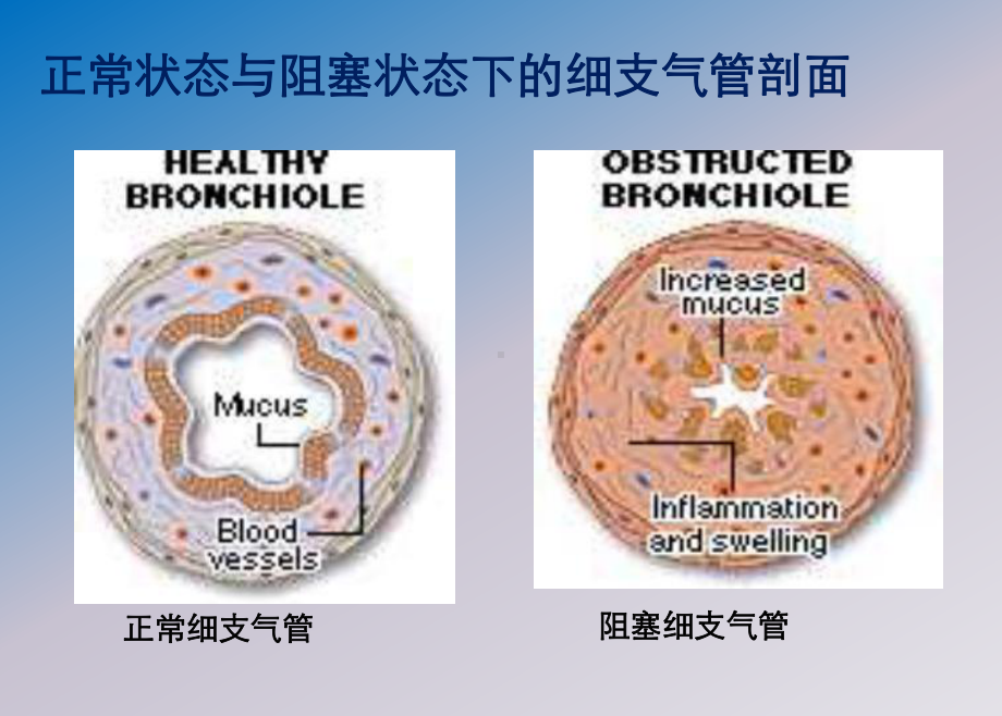 哮喘健康教育支气管哮喘防治PPT课件.ppt_第2页