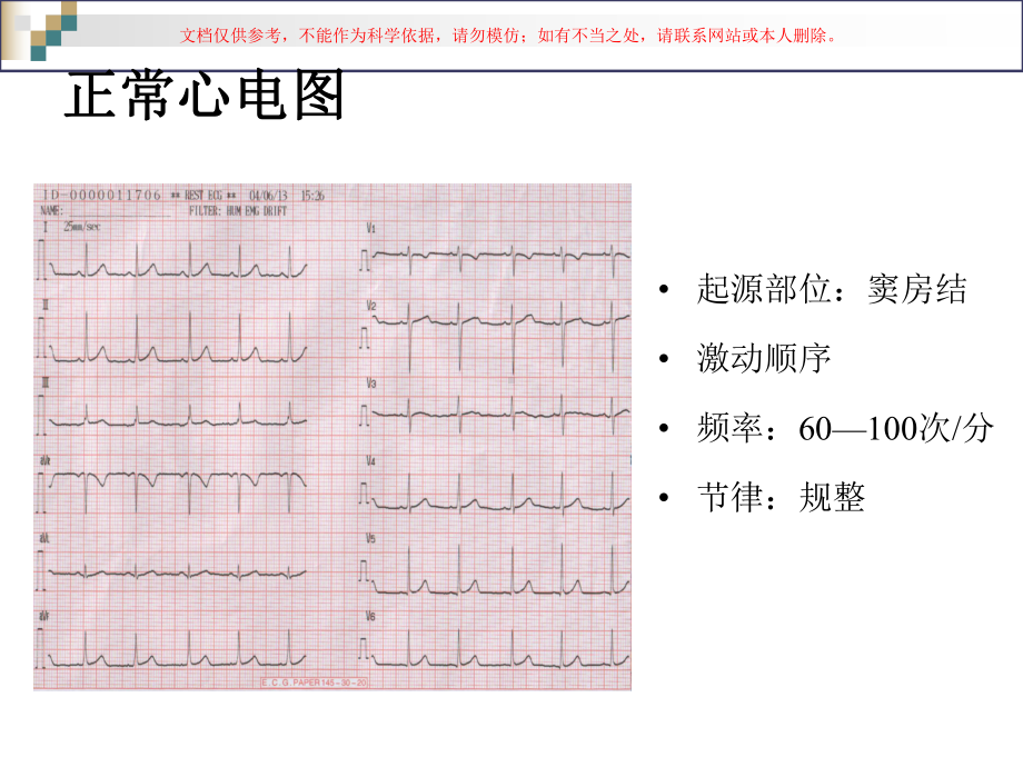 严重心律失常的急救和护理课件.ppt_第3页