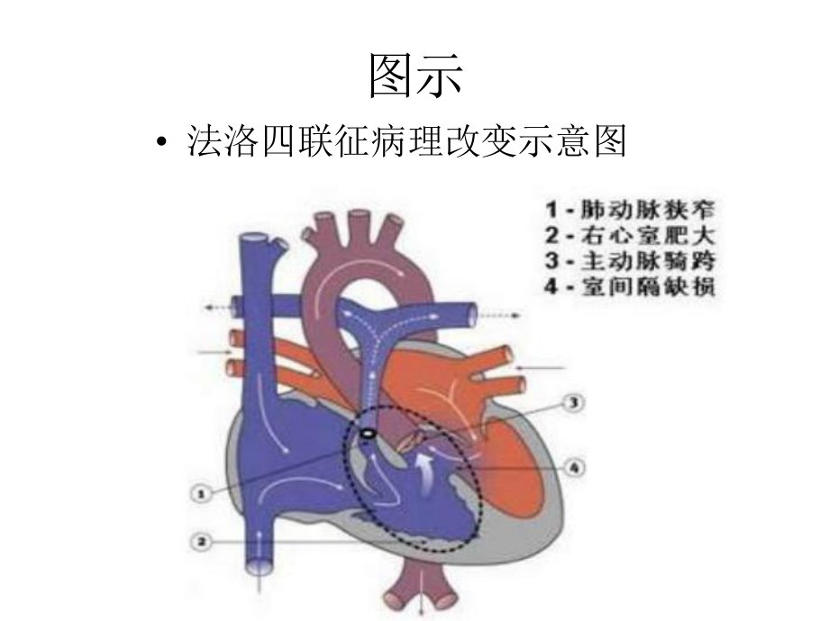 医学课件肺动脉瓣狭窄的超声.ppt_第2页