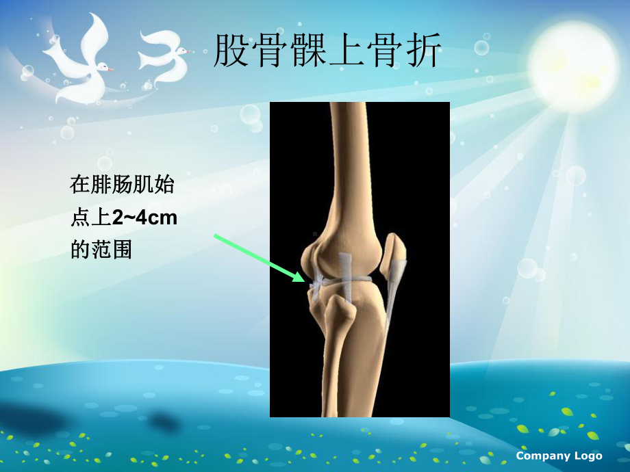 左股骨髁上骨折术后护理终版课件.ppt_第2页