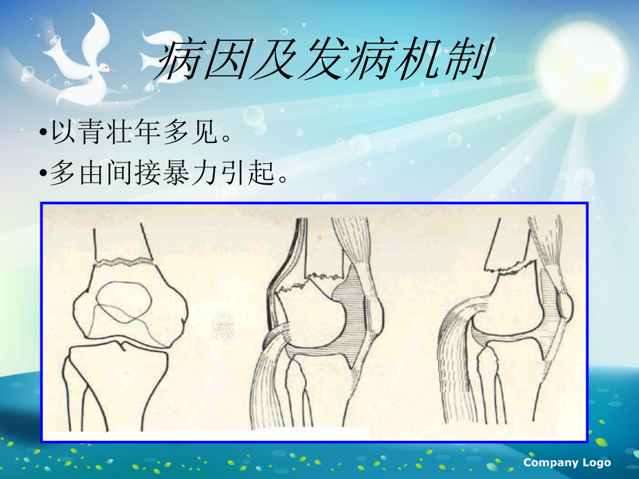 左股骨髁上骨折术后护理终版课件.ppt_第3页