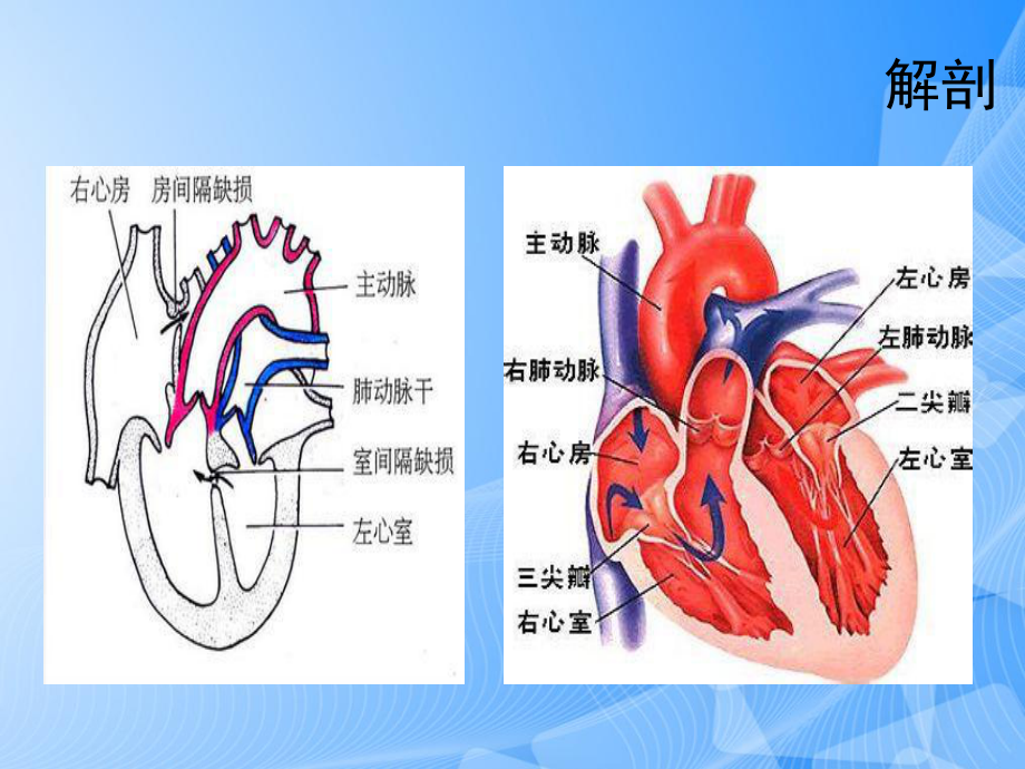 房间隔缺损护理查房PPT.ppt_第3页