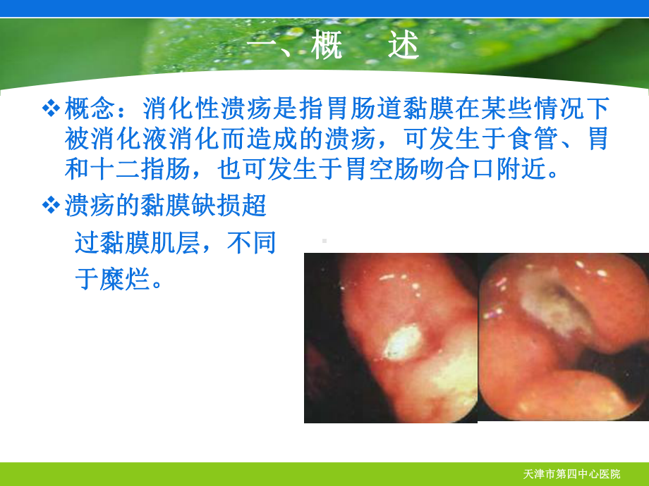 全科消化性溃疡PPT幻灯片课件.ppt_第2页