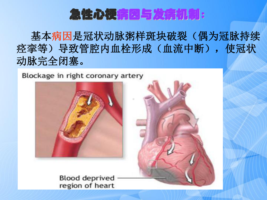 急性心梗溶栓的护理PPT.ppt_第3页