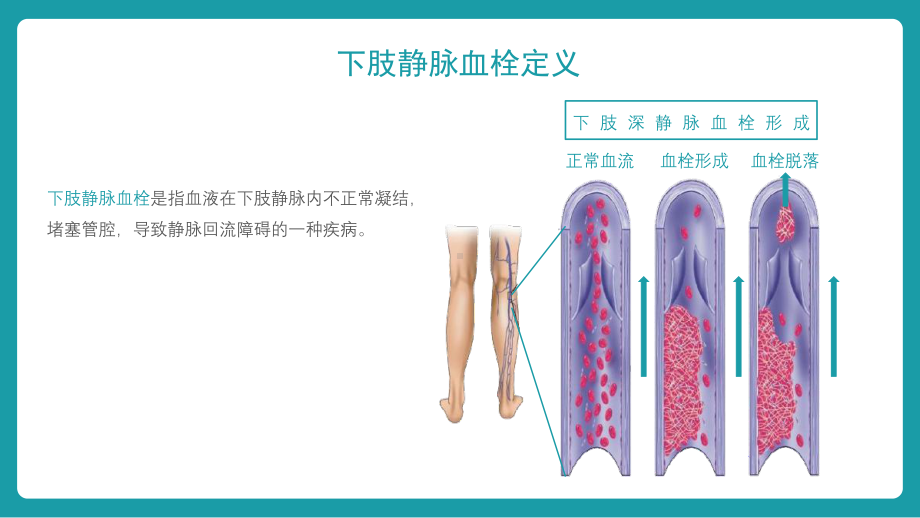 下肢静脉血栓查房课件.pptx_第2页