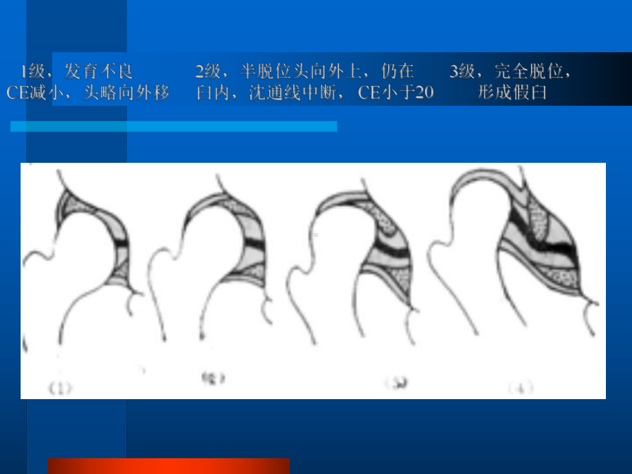 发育性髋关节异常课件.ppt_第3页