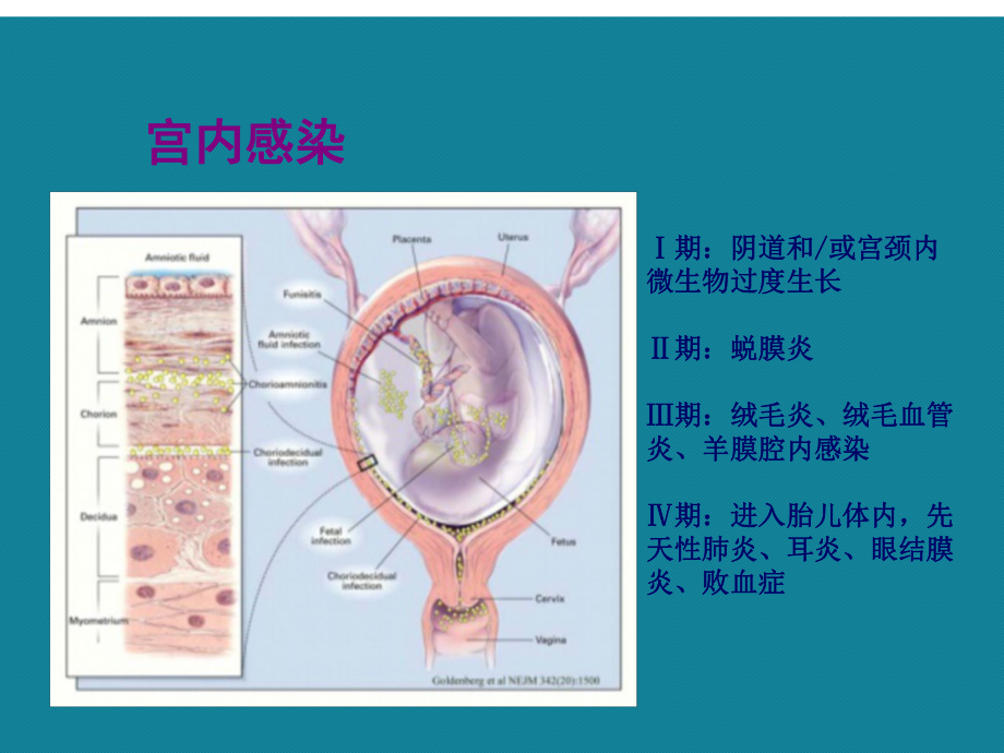 优选围生期感染课件.ppt_第2页