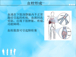 下肢深静脉血栓医学知识课件.ppt