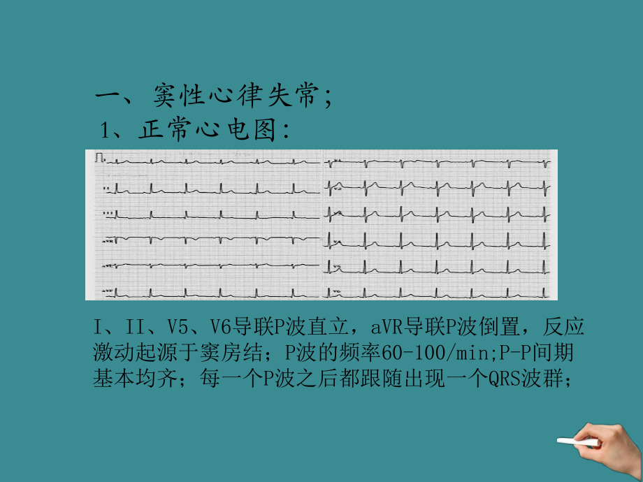 常见心电图解析课件.ppt_第2页