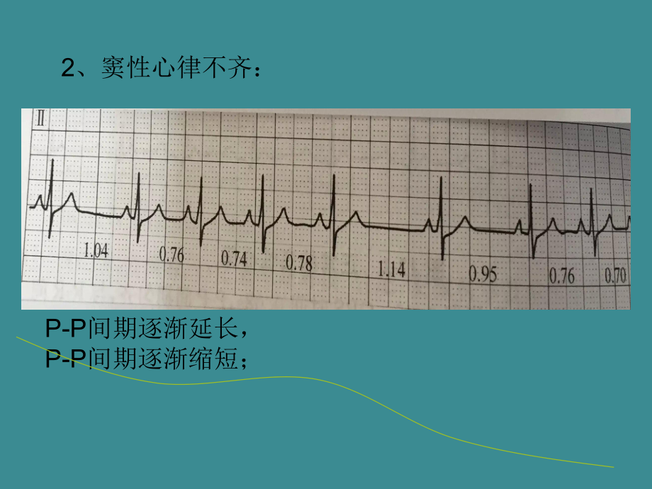 常见心电图解析课件.ppt_第3页