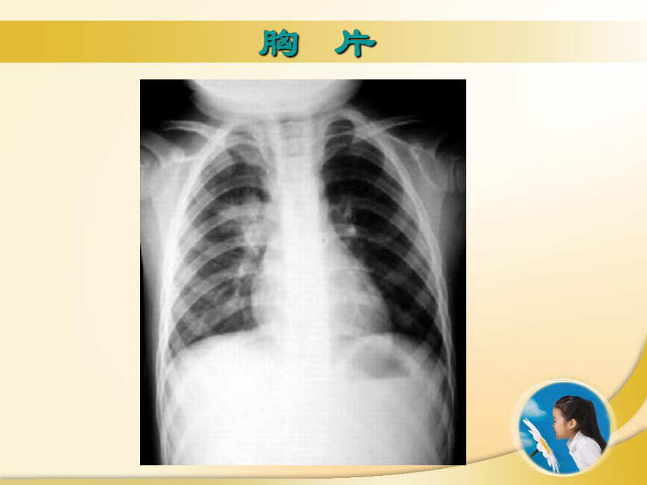 儿科典型病案分析-肺炎典型病例课件.ppt_第3页