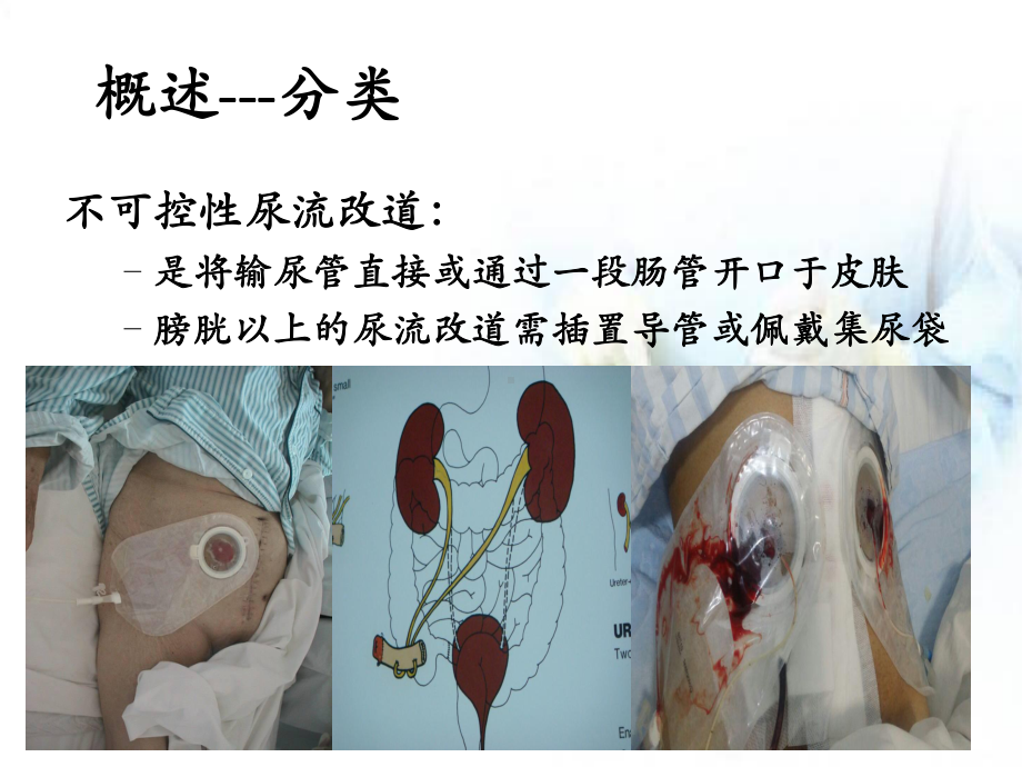 尿路造口患者的护理课件 (2).ppt_第3页