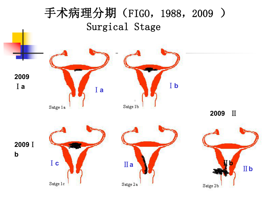 早期子宫内膜癌术后辅助治疗课件.ppt_第3页