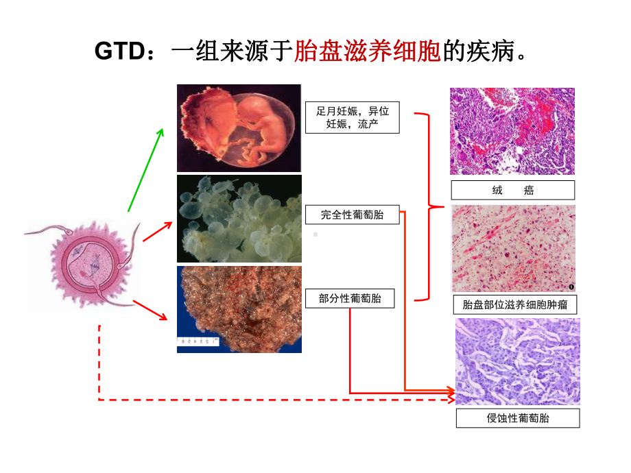 （PPT）-妊娠滋养细胞疾病GestationalTrophoblasticDiseaseGTD课件.ppt_第2页