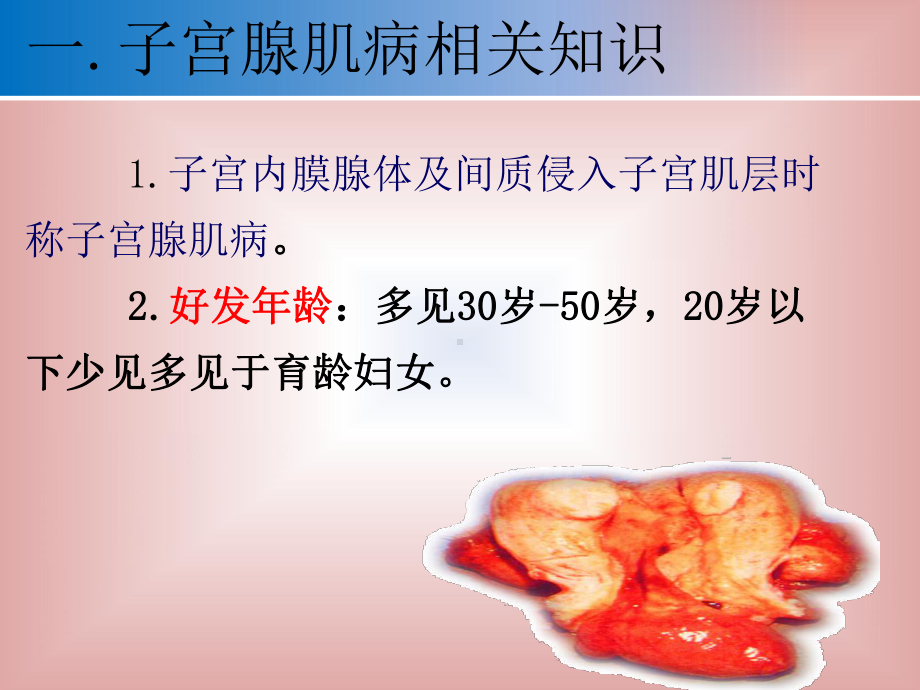 子宫腺肌病PPT课件.ppt_第3页