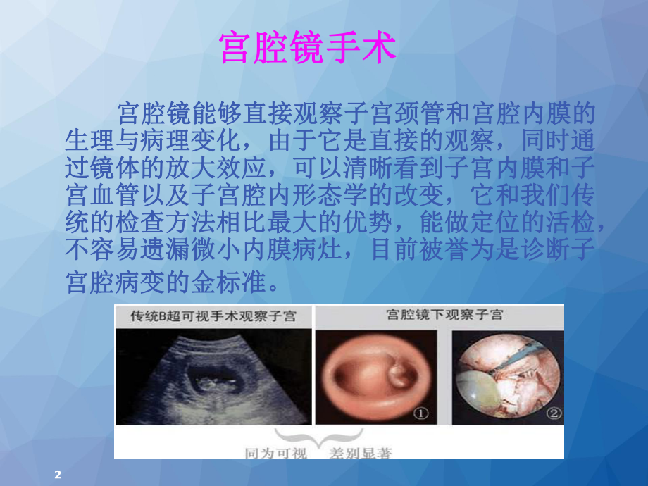 后腹腔镜下肾囊肿去顶减压术ppt课件.ppt_第2页