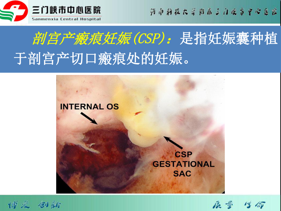 剖宫产瘢痕妊娠PPT课件.ppt_第2页