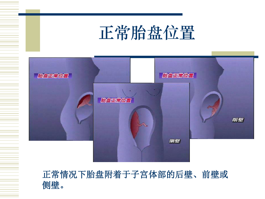 前置胎盘病人的护理课件.ppt_第2页